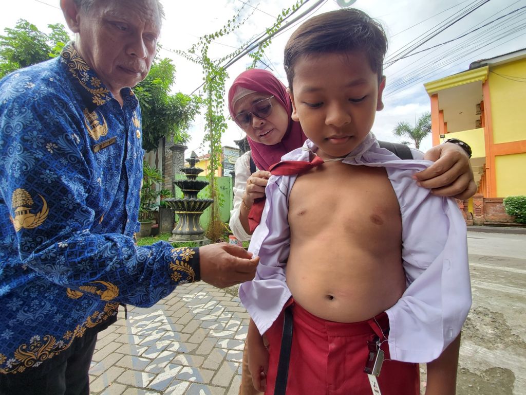 Salah satu siswa SD di Kota Mojokerto yang diserang ulat bulu